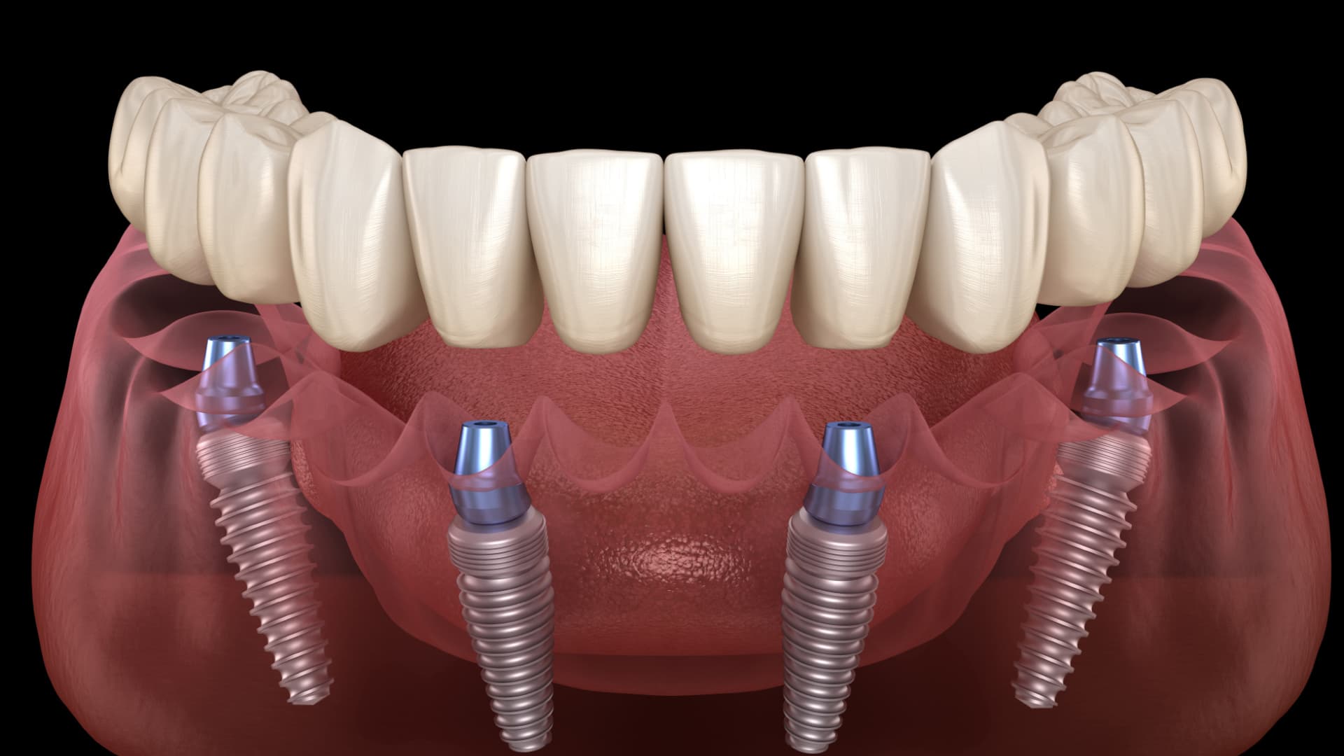 All-on-6 and All-on-8 Dental Implants in Thailand