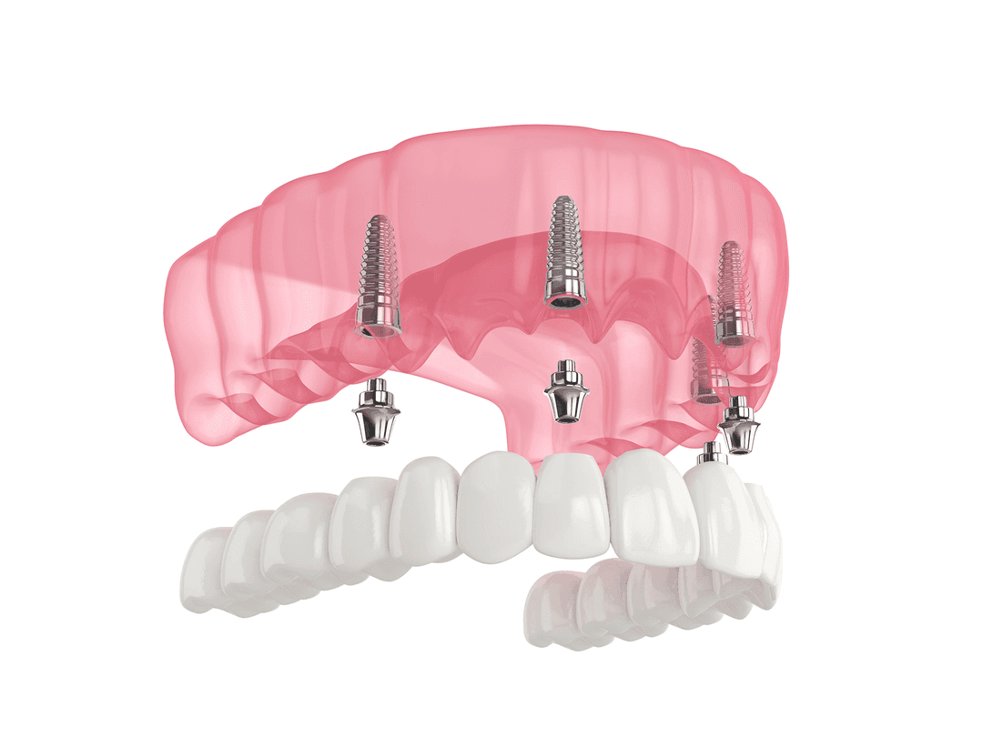 All-on-4 Dental Implants: Pros, Cons, and What They Really Cost