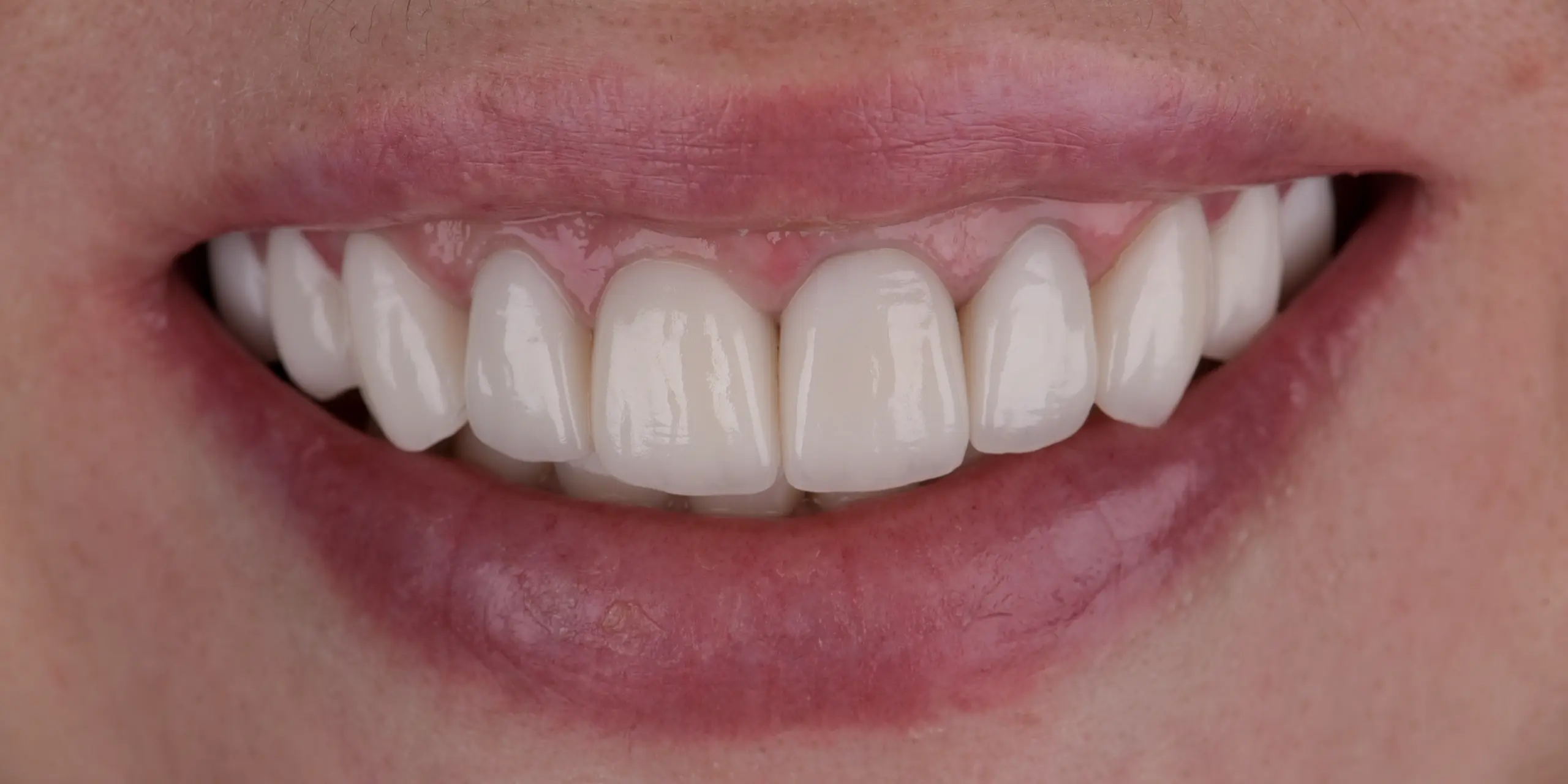 Julie P. — after วีเนียร์พอร์ซเลน 10 ซี่