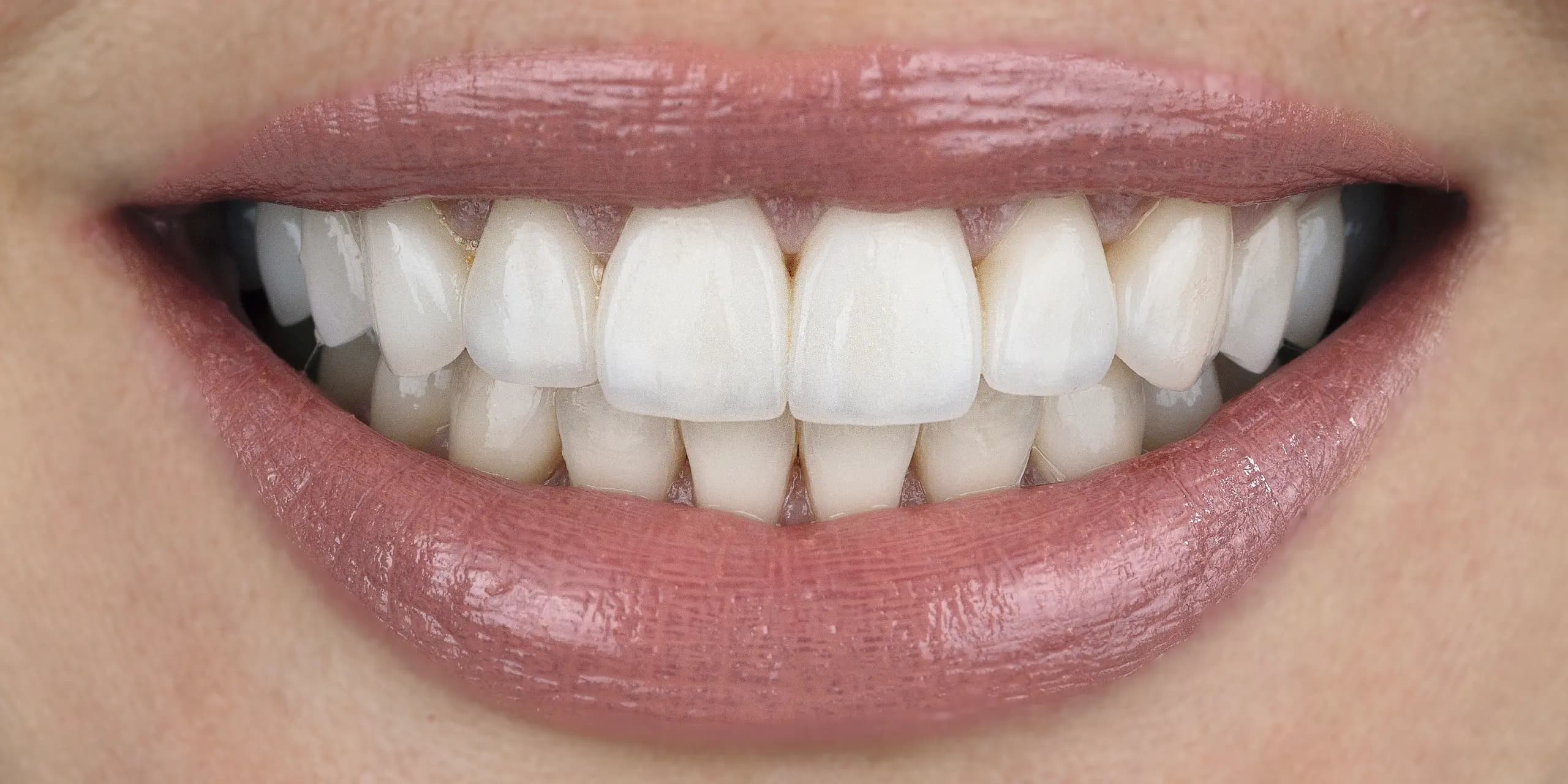 After — วีเนียร์พอร์ซเลน 18 ซี่ at Dental Veneer Bangkok