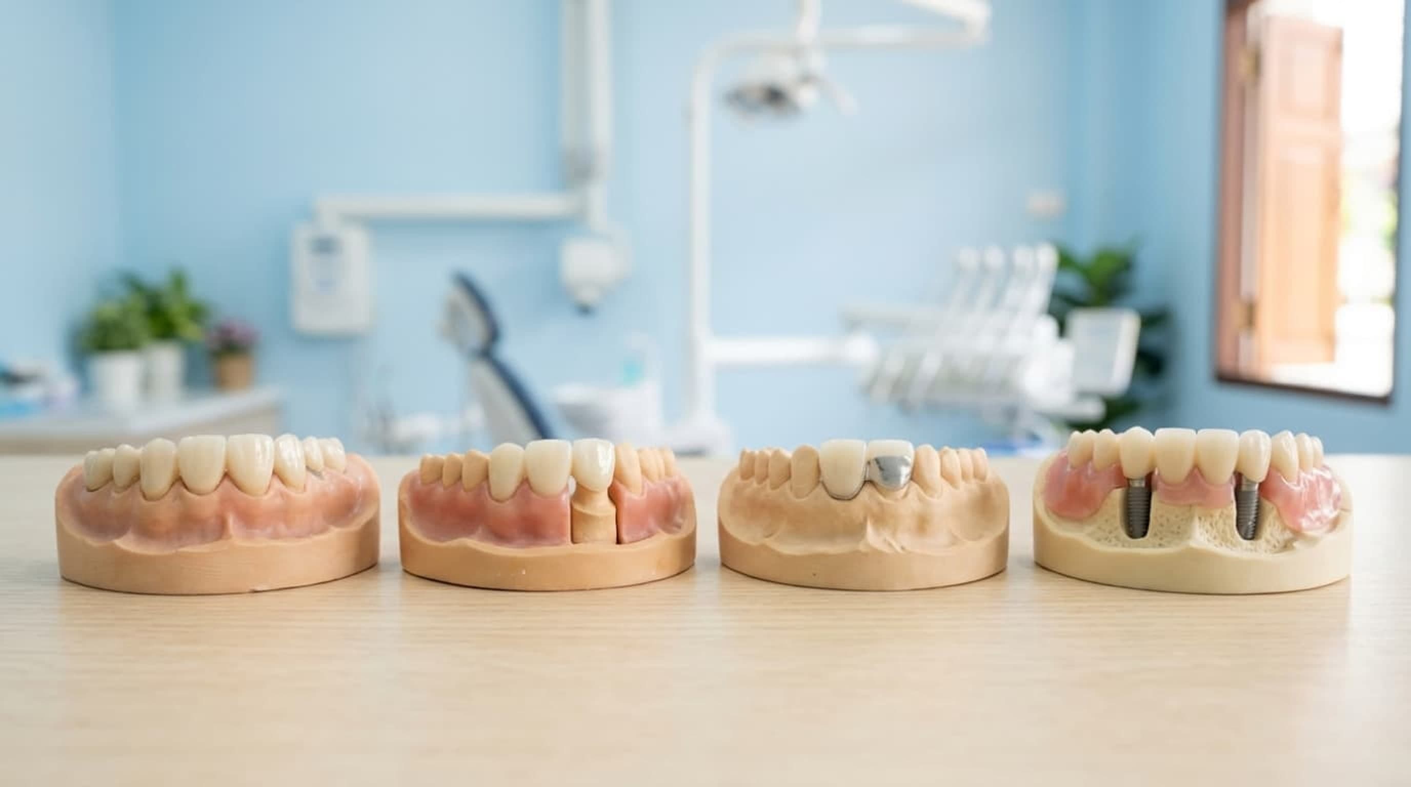 Don't Want Dentures? 4 Real Alternatives and What They Cost in Bangkok