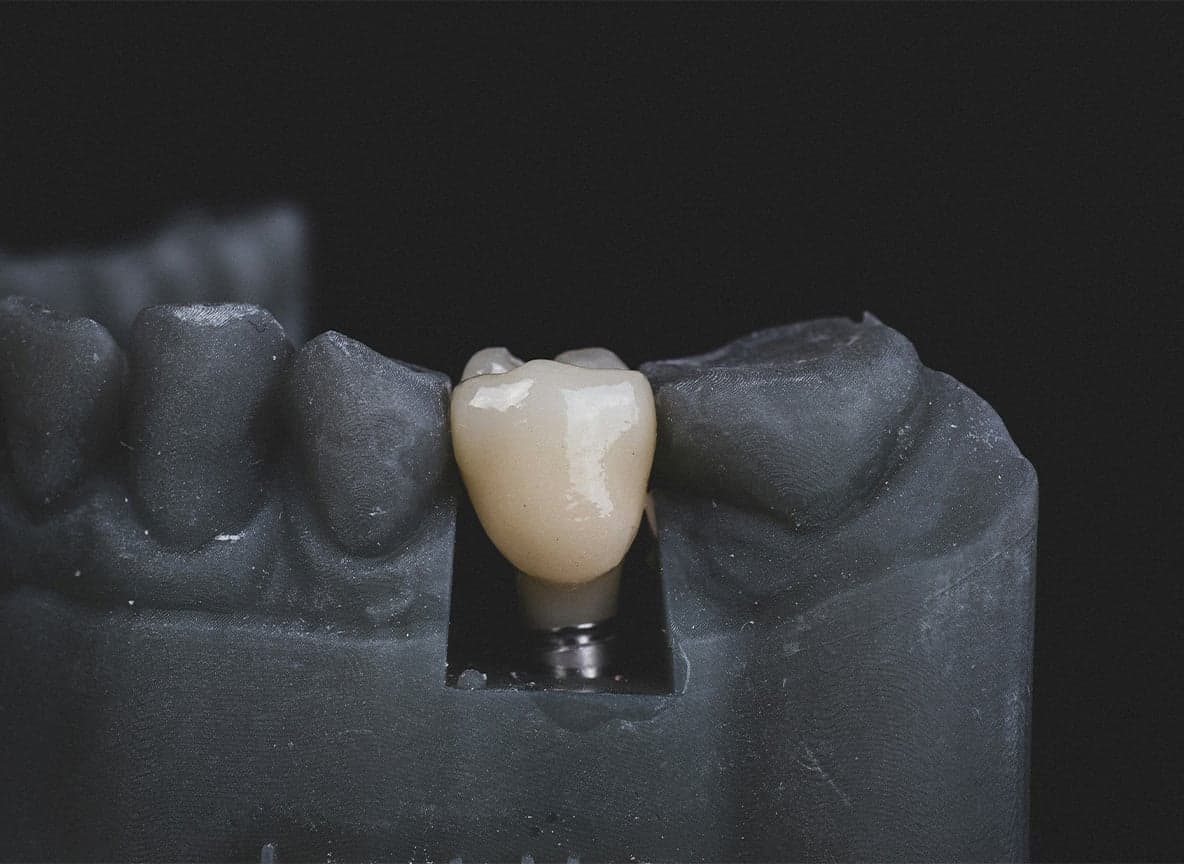 How Much Dental Implants Really Cost in Thailand | Guide for 2026