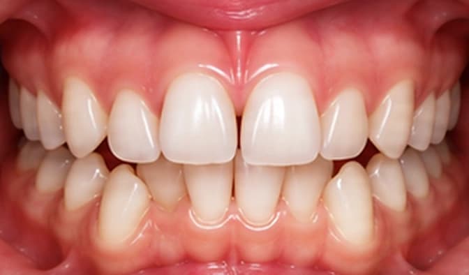 Before — Crowded front teeth