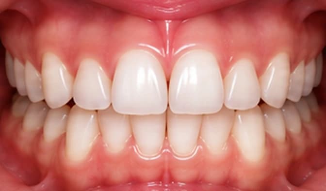 Month 3 — Noticeable improvement
