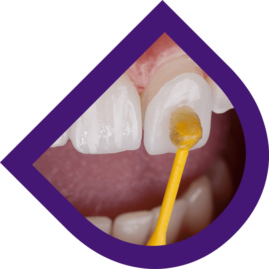 Dental veneers Bangkok