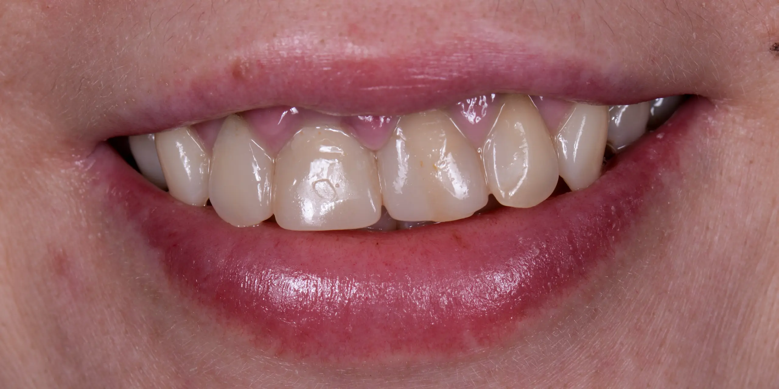 Before porcelain veneers treatment showing discolored and uneven teeth