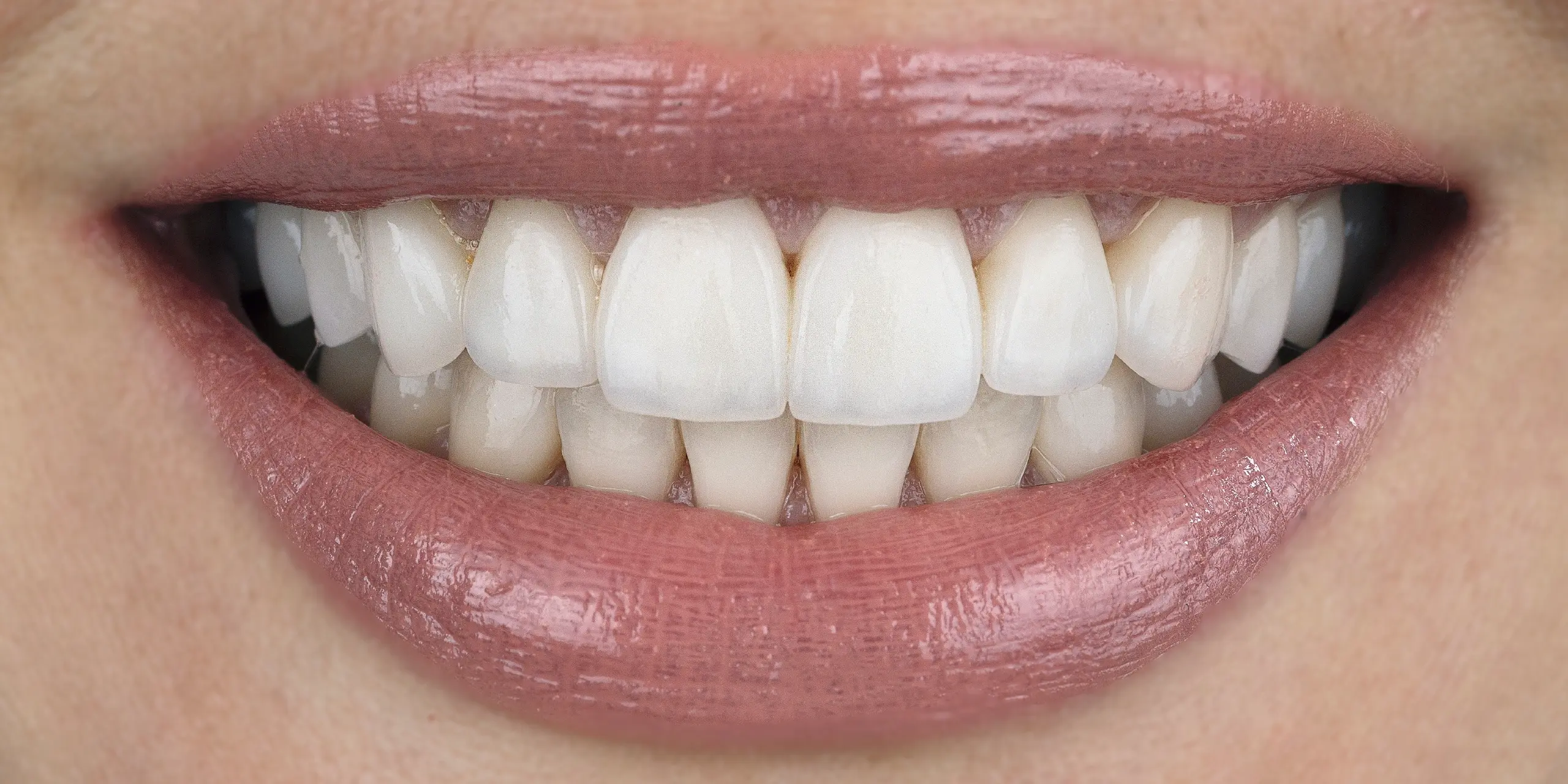 Before and after comparison of a patient's smile showing the colour and shape change after veneer treatment