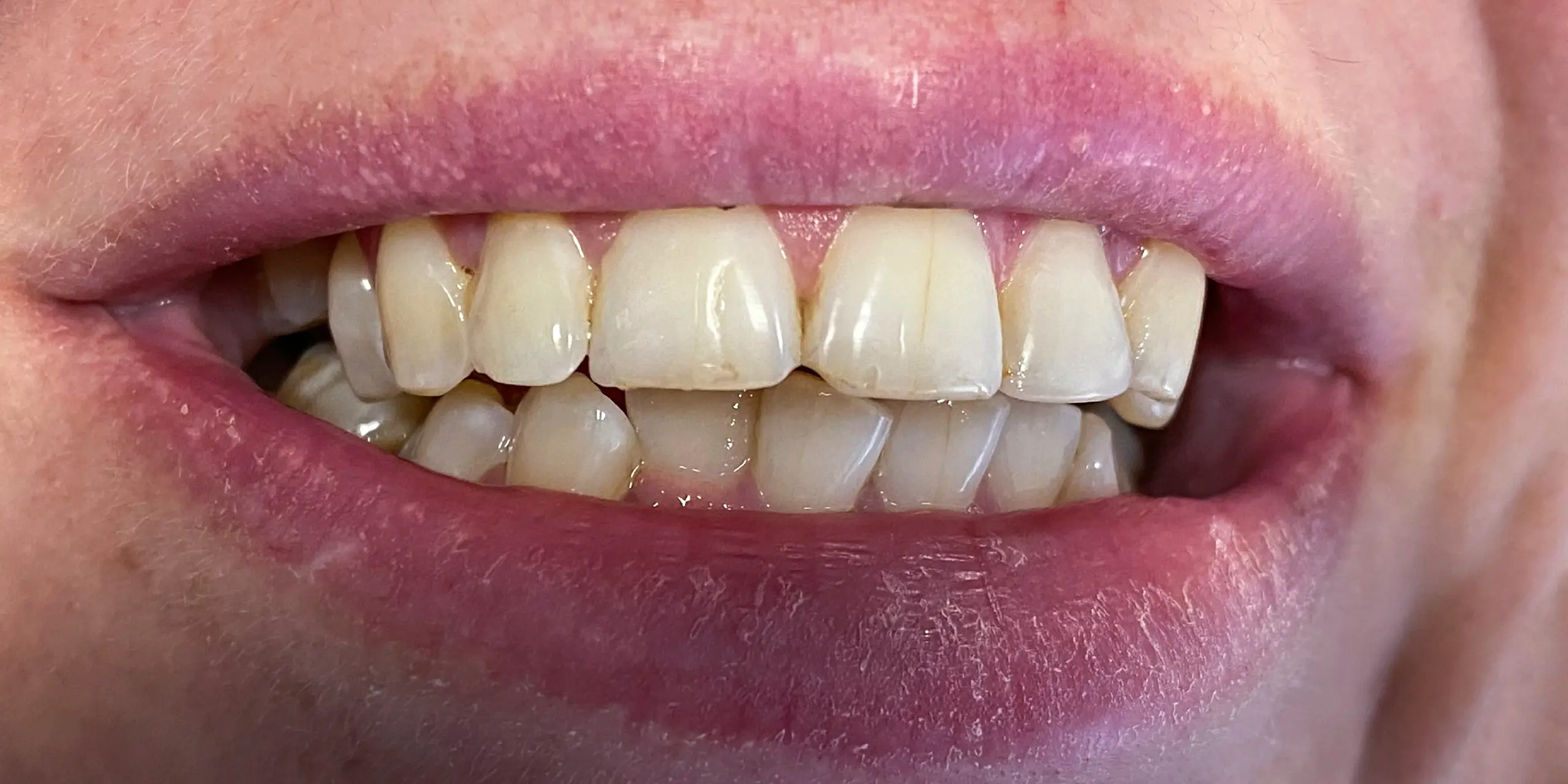 Close-up of a restored smile after a dental bridge replacing a missing tooth