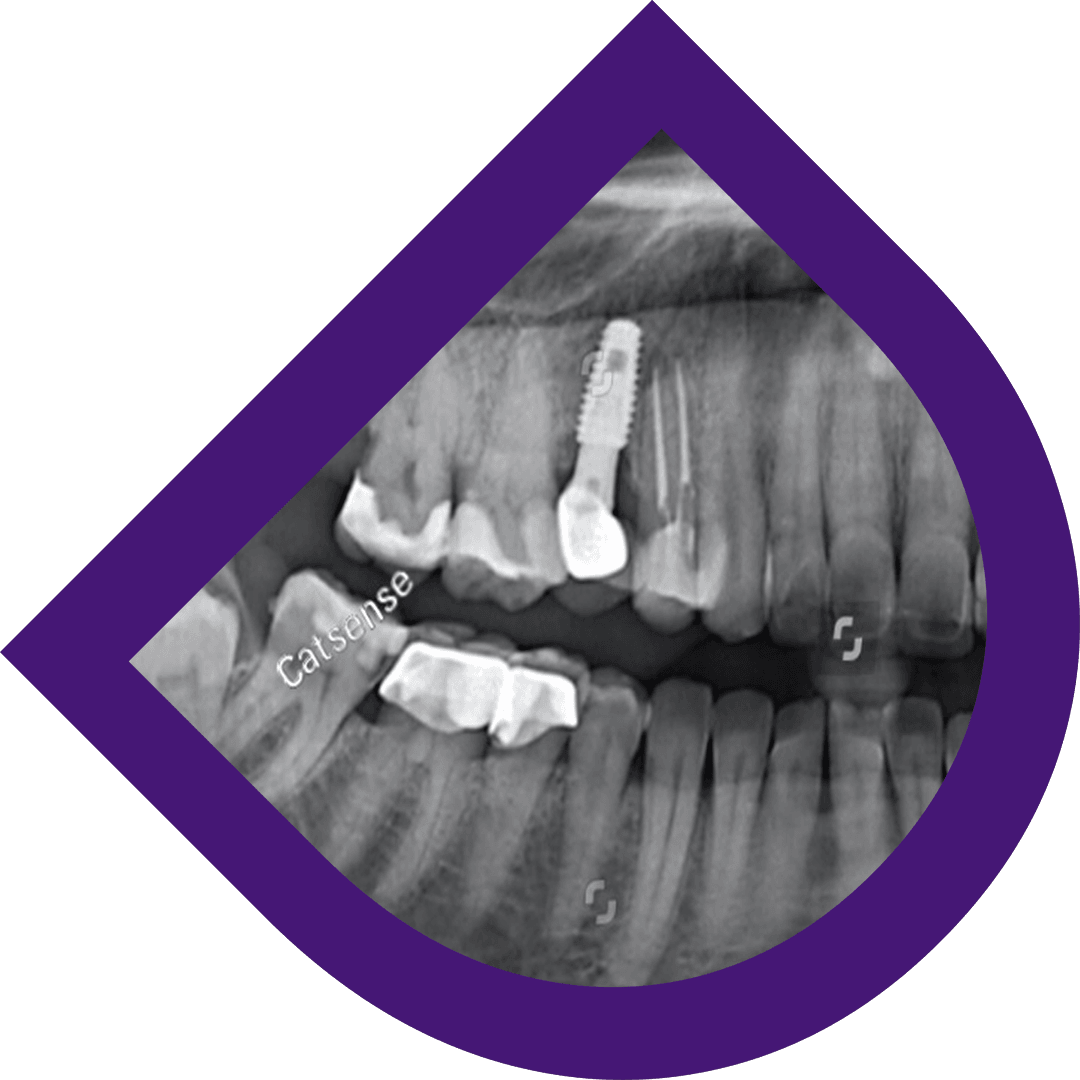Single dental implant model showing a titanium post and crown used for tooth replacement in Bangkok