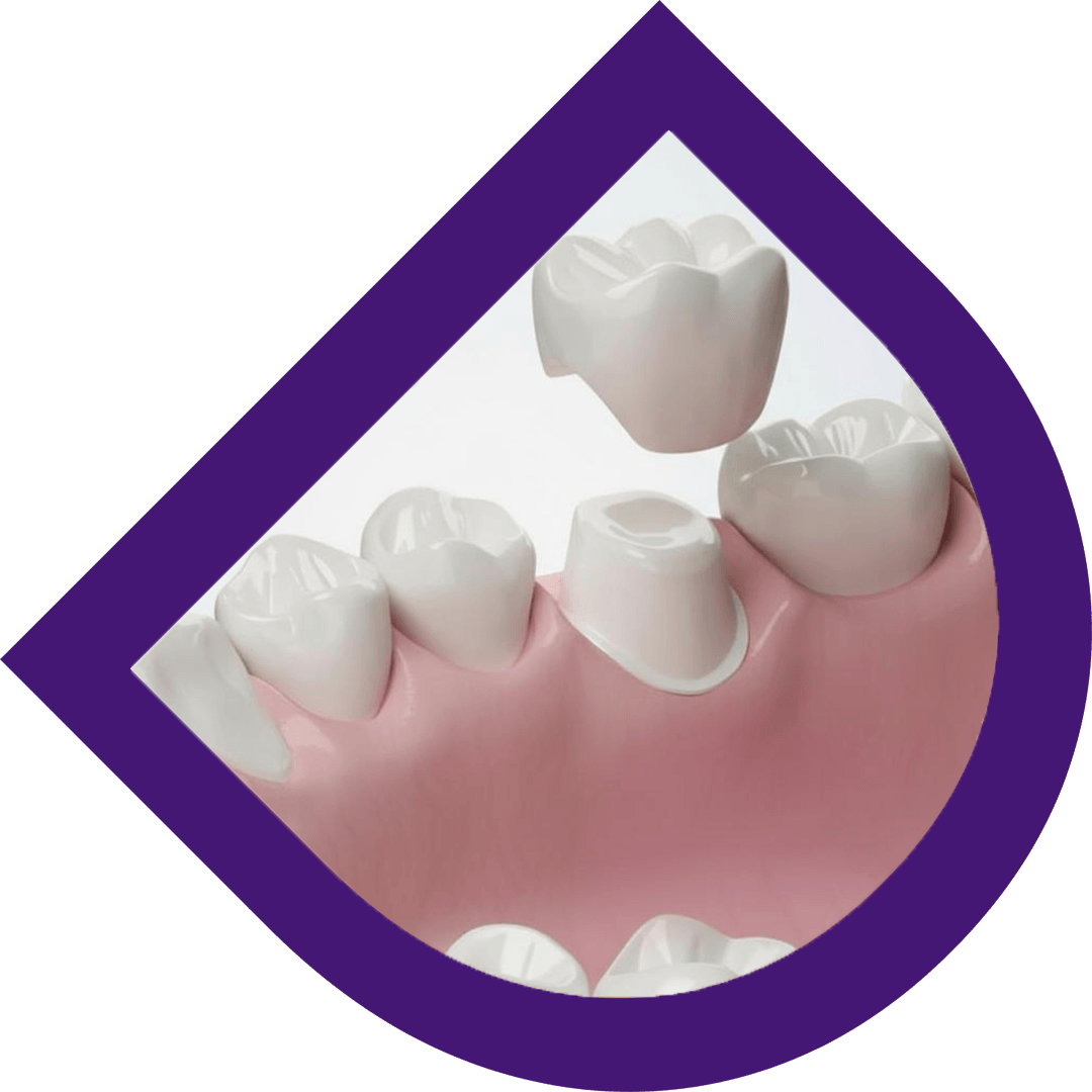 Comparison of zirconia and all-ceramic E-max dental crowns made in a Bangkok dental laboratory