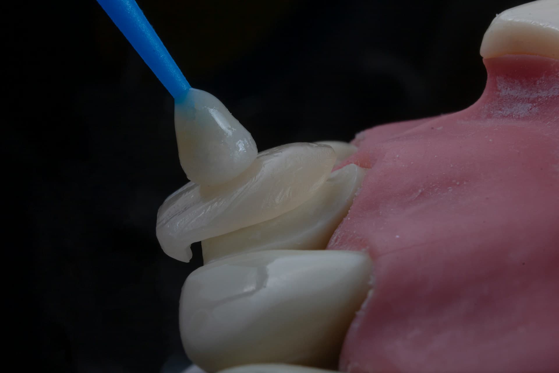 Composite veneers result in Bangkok