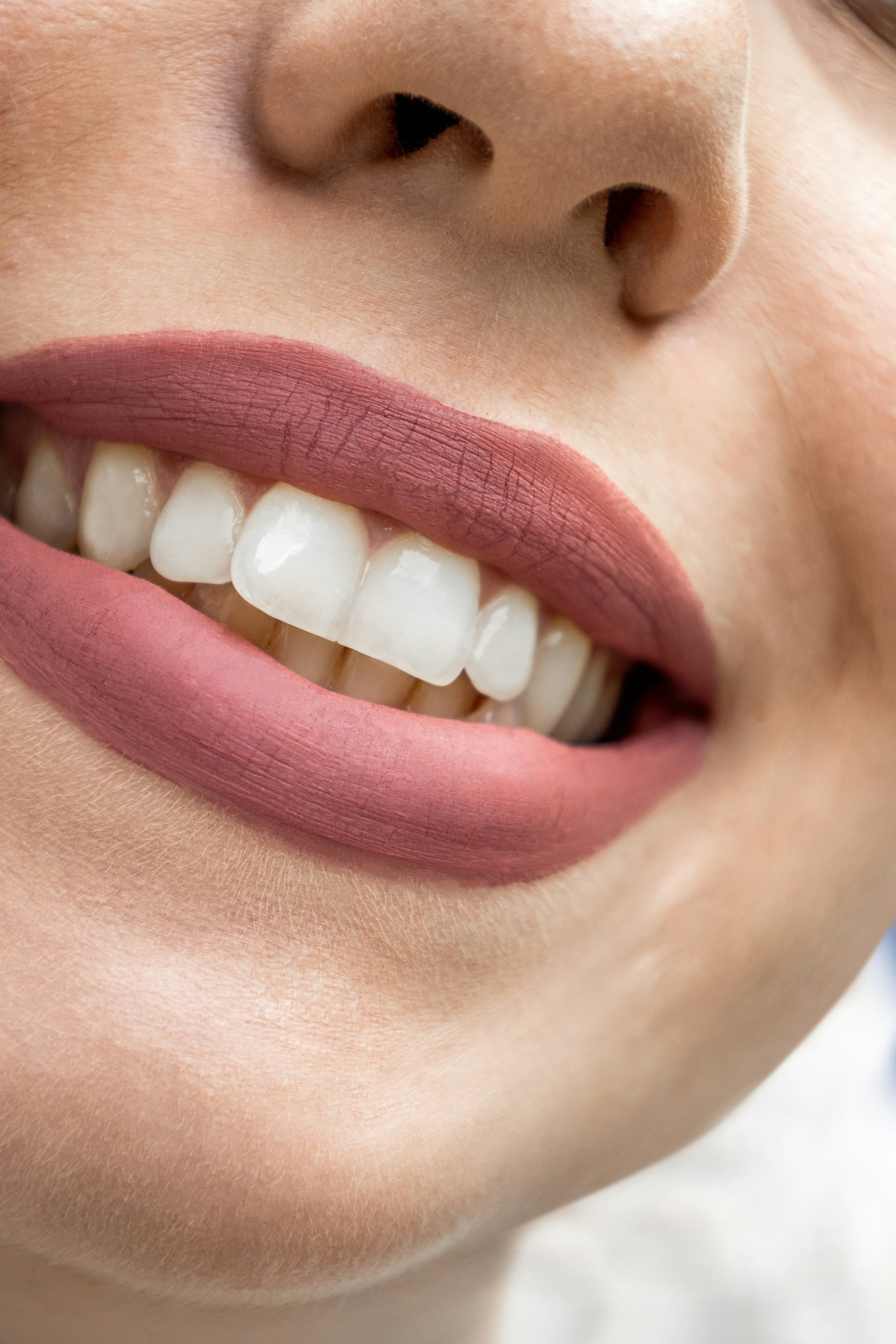 Composite veneers smile transformation in Bangkok