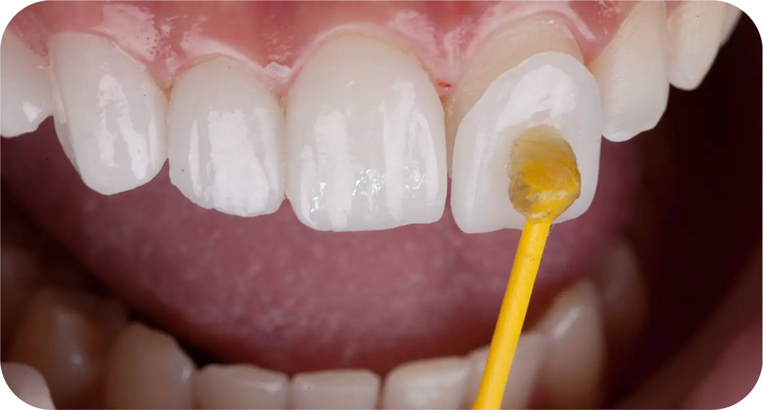 Porcelain Veneers Bangkok