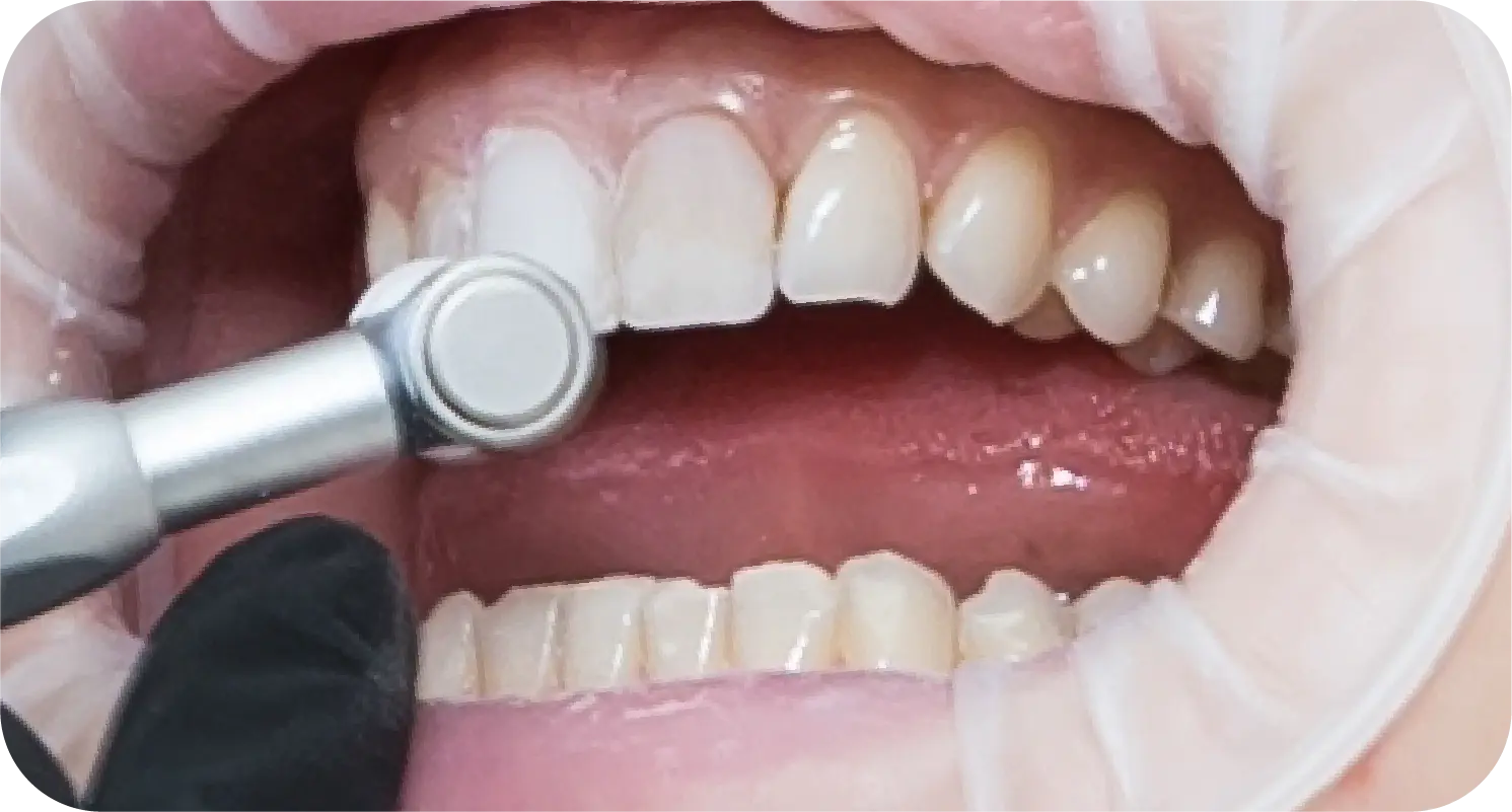 Composite Veneers